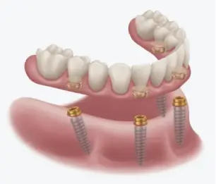 Illustration of a full lower arch of teeth seated on four dental implants
