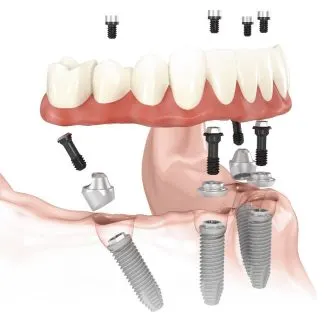 Illustration of a full arch of zirconia teeth seated on six dental implants