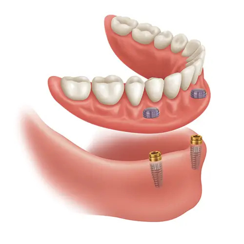 Illustration of a lower denture lifted above two dental implants with locator attachments