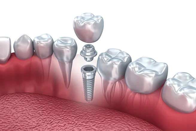 Illustration of a single dental implant: the crown and abutment lifted above the titanium post between natural teeth