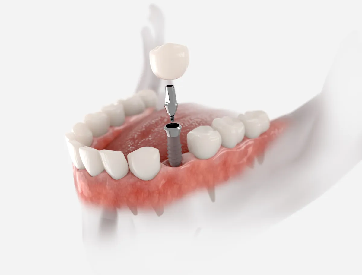 Illustration of a single dental implant: the titanium post in the jaw, the abutment, and the crown above it